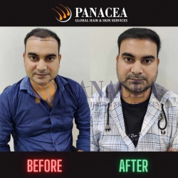 Panacea Real Result - Hair Transplant in Delhi